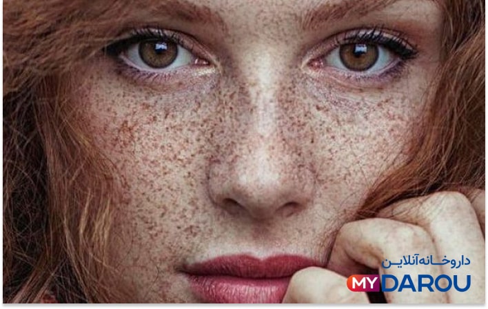 مای دارو - بهترین کرم های ضد لک ایرانی بدون بازگشت