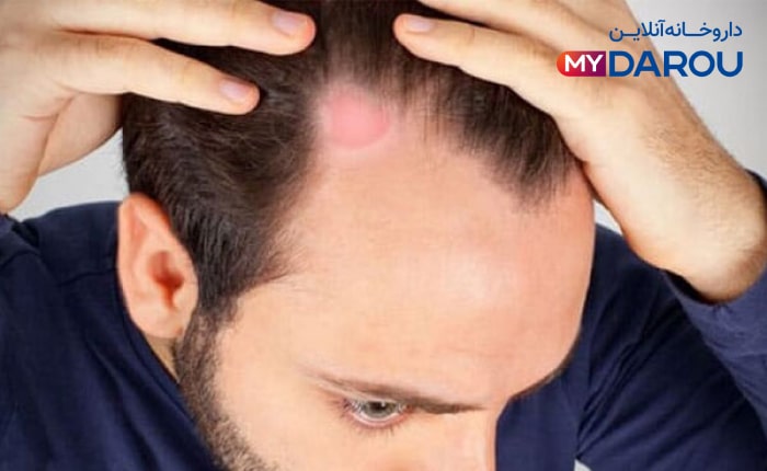 مای دارو - بهترین شامپو ضد شوره و قارچ